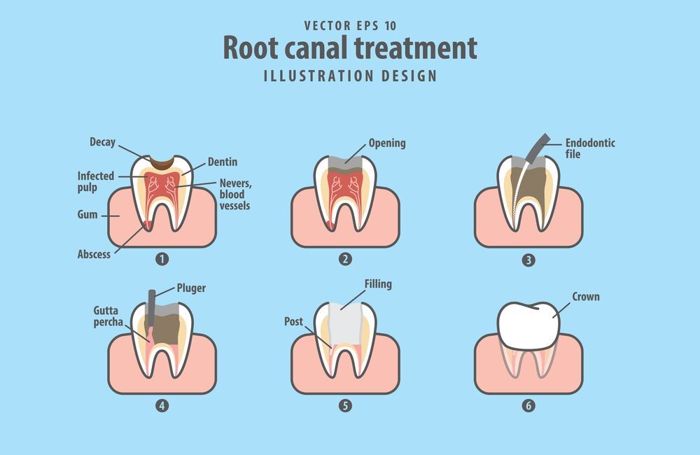Root Canal or Extraction Which Choice is Best? Cedar Spring Dentistry